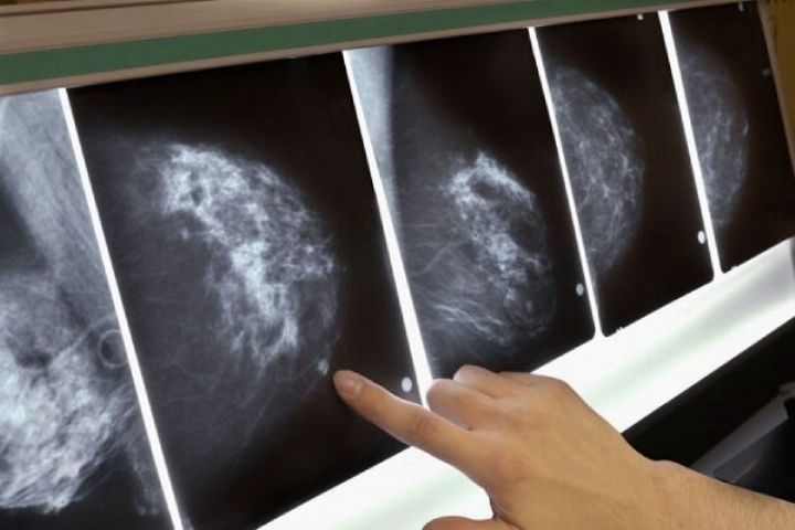 شناسایی فاكتور پرخطر احتمالی سرطان سینه