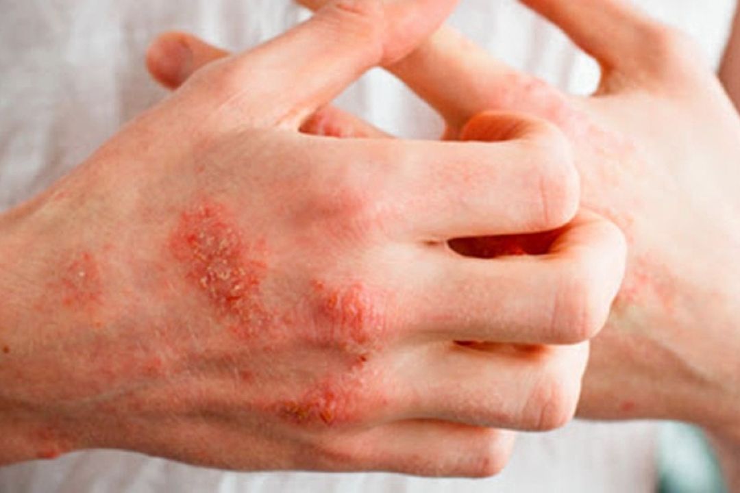 متخصص پوست و مو: مهمترین علت اگزما ژنتیك است و به هیچ وجه قابل سرایت نیست