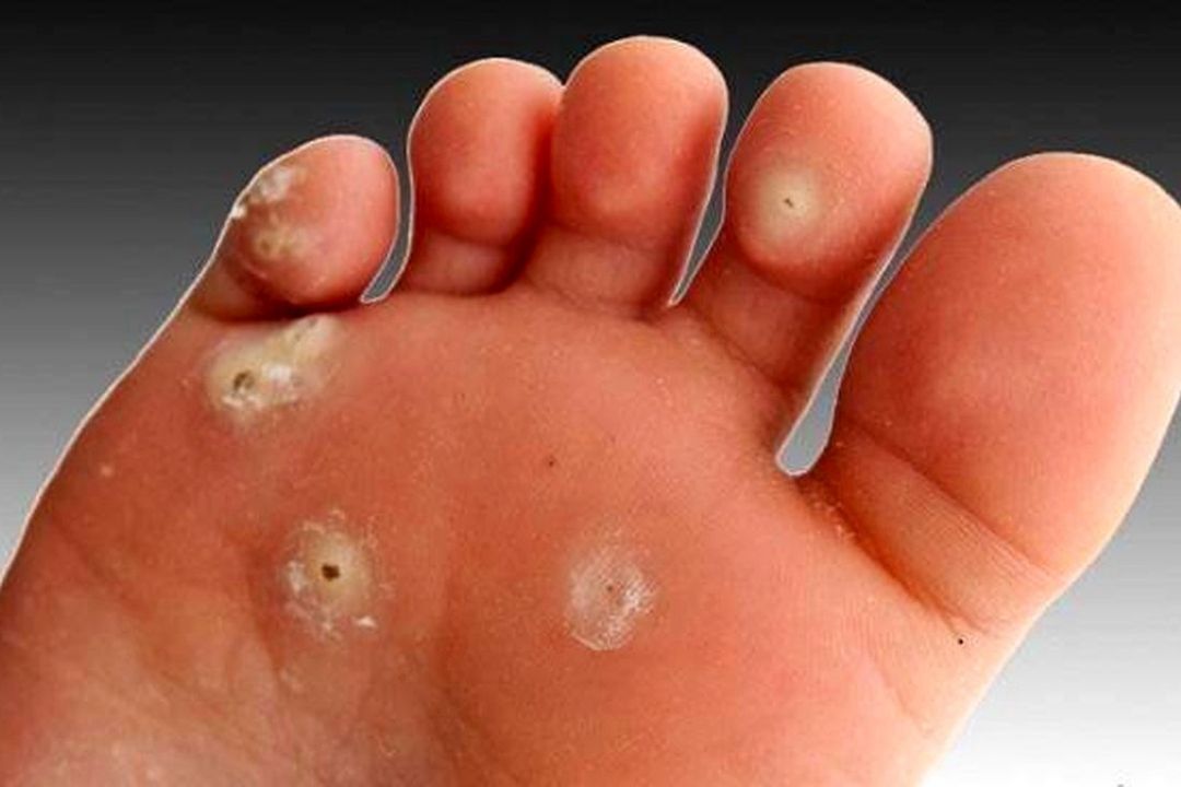 میخچه و زگیل پا؛ علت و علائم و و روش‌های درمان