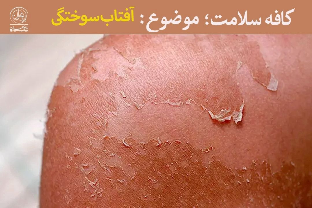 چه افرادی بیشتر دچار آفتاب سوختگی می‌شوند؟