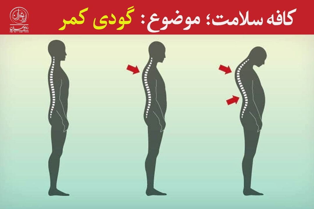 گودی كمر؛ عوارض و راه‌های درمان