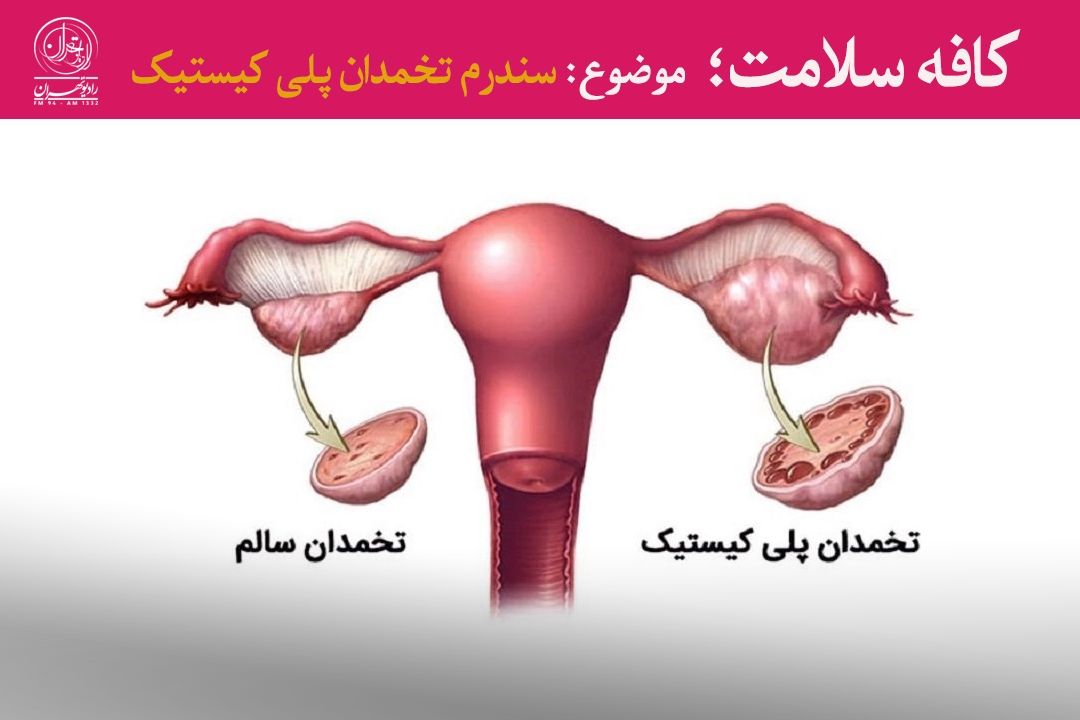 پیشگیری از سندروم تخمدان پلی‌كیستیك با تغییر سبك زندگی