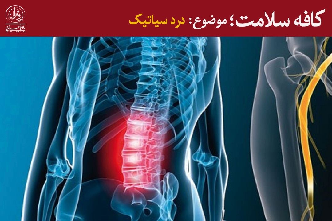 چگونه از درد سیاتیك پیشگیری كنیم؟