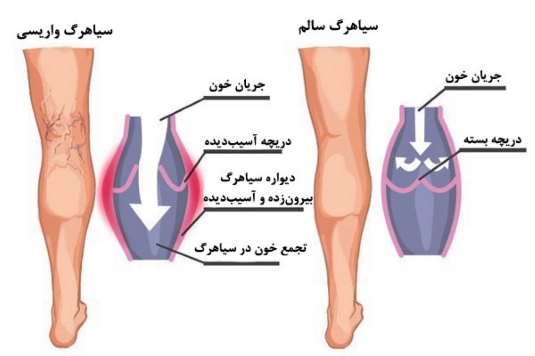 «سایه روشن» از درمان كننده های واریس می گوید