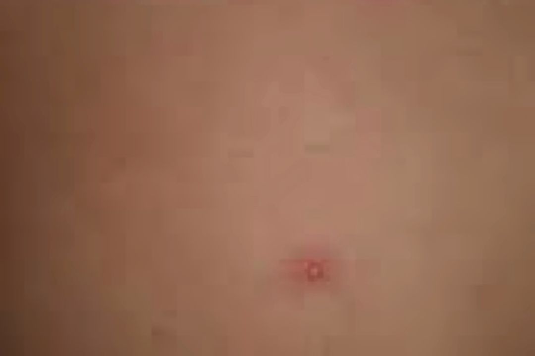 اگر آبله مرغان نگرفته اید، امكان ابتلا به زونا وجود دارد؟