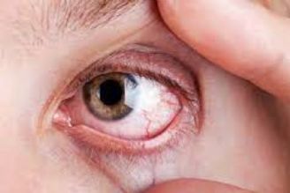 علت و علائم بیماری خشكی چشم چیست؟