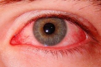احتمال عفونت قرنیه در لنزهای رنگی بیشتر است