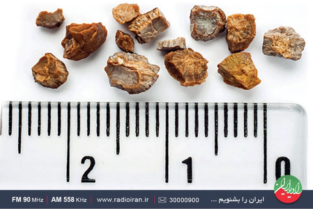 نكات شنیدنی در خصوص سنگ كیسه صفرا