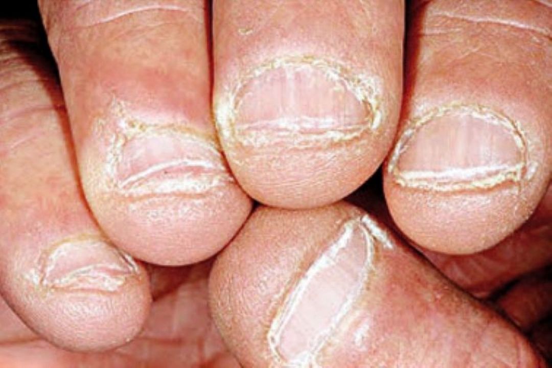 شكنندگی و تغییر رنگ‌ ناخن‌‌ها را جدی بگیرید
