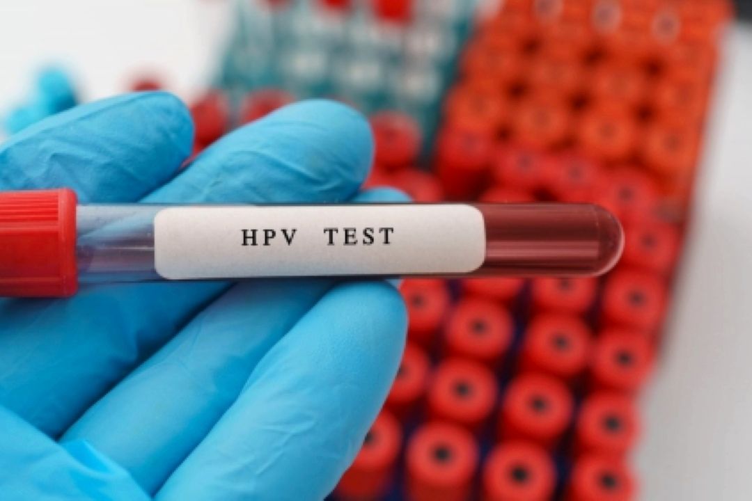 كیت غربالگری ویروس HPV تولید شد 