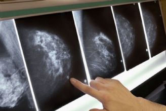 شناسایی فاكتور پرخطر احتمالی سرطان سینه