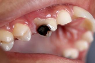 پوسیدگی زودرس دندان نشانه كمبود ویتامینD است