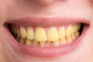 5 عادت غلطی كه دندانتان را زرد می كند