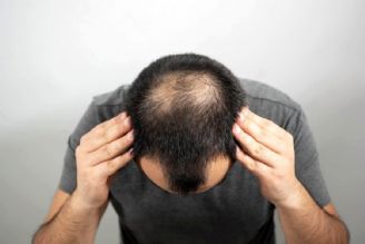 شناسایی ژن‌های نادر عامل ریزش مو در مردان 