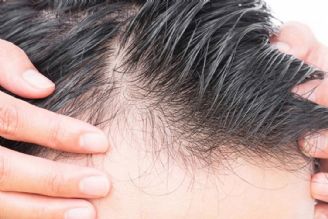 بررسی انواع ریزش مو و مشكلات آن