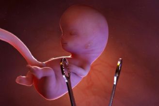 سقط عمدی 530 هزار جنین در سال 