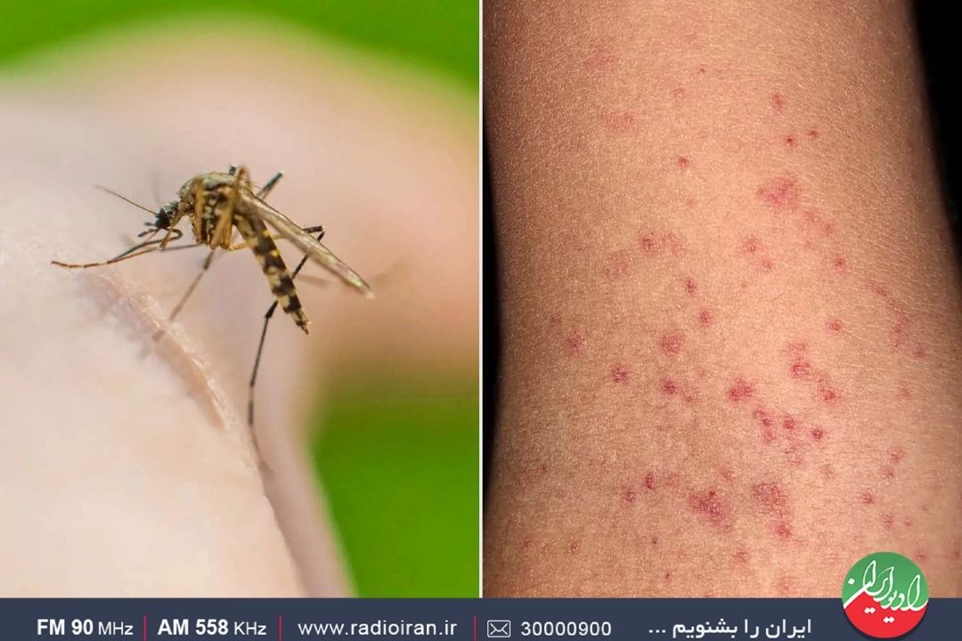 تب دنگی در دنیا شیوع زیادی پیدا كرده است