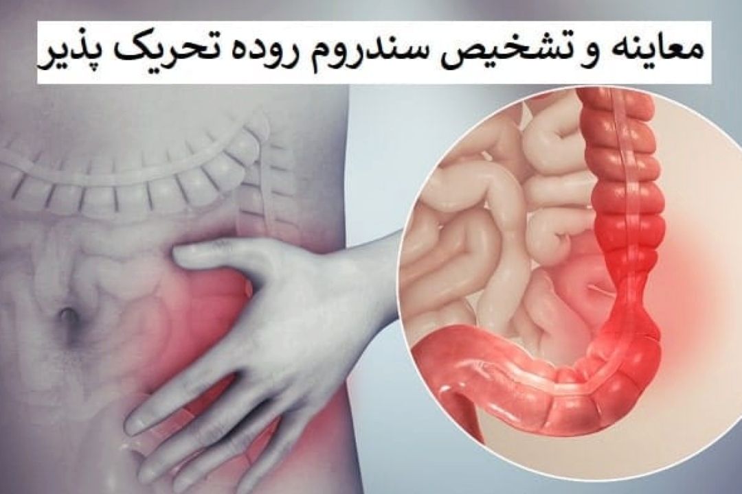 سندرم روده تحریك پذیر در "مجله پزشكی" 