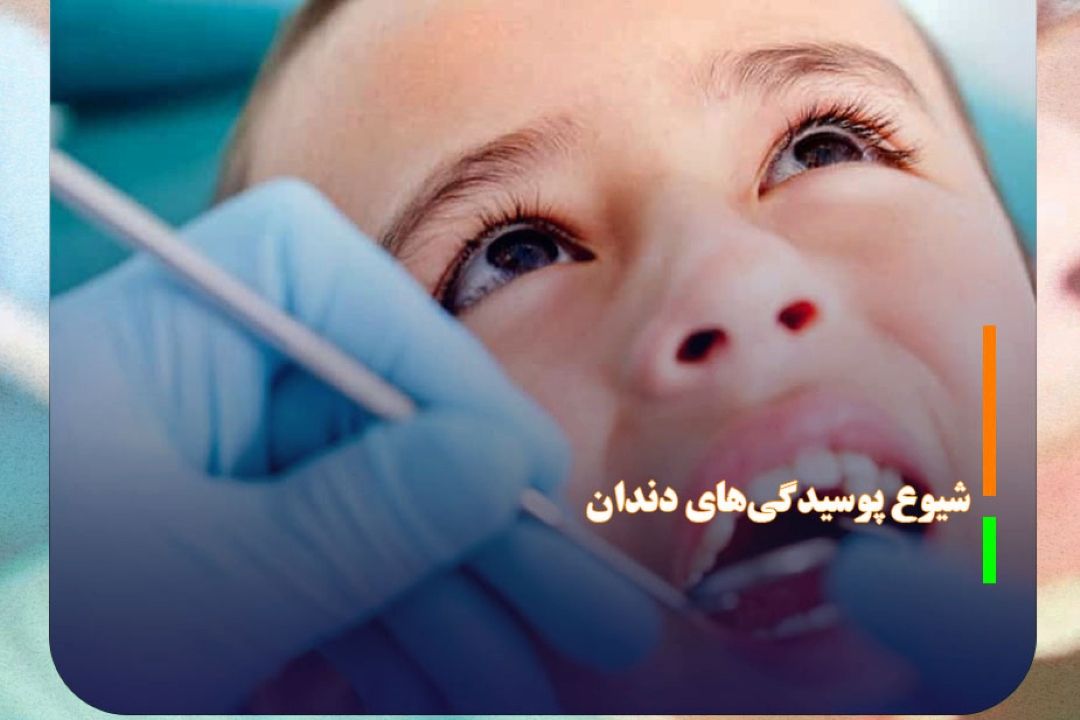 شیوع پوسیدگی‌های دندان در كشور