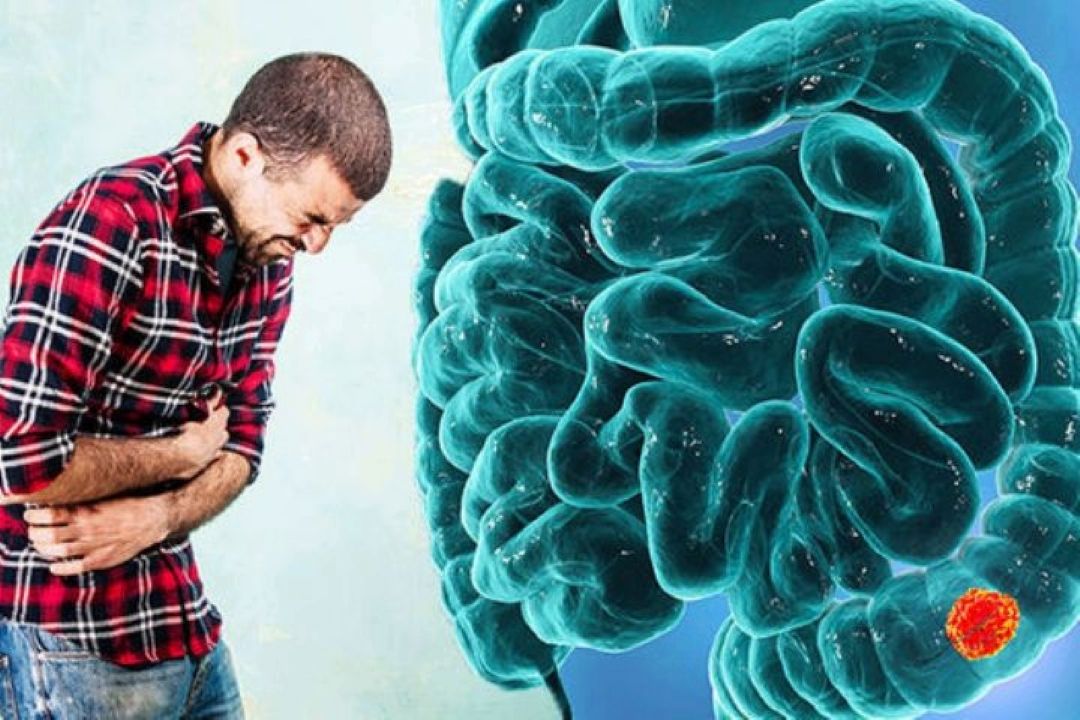یبوست همراه با نفخ؛ زنگ هشدار یا اختلال شایع گوارشی؟