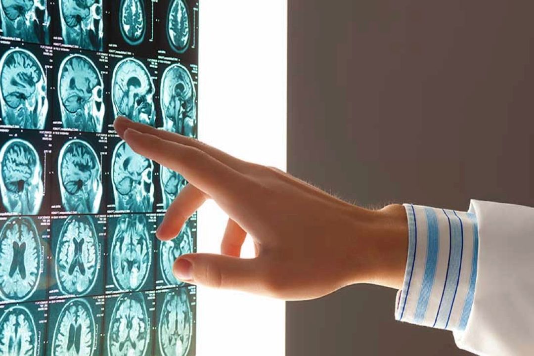  شناسایی زودرس علائم سكته مغزی، كلید طلایی درمان