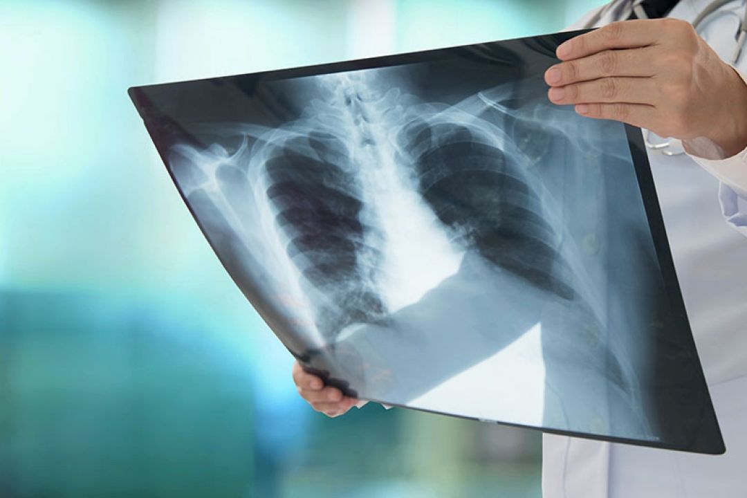  ضرورت آگاهی عمومی درباره عفونت‌های ریوی و بیمارستانی