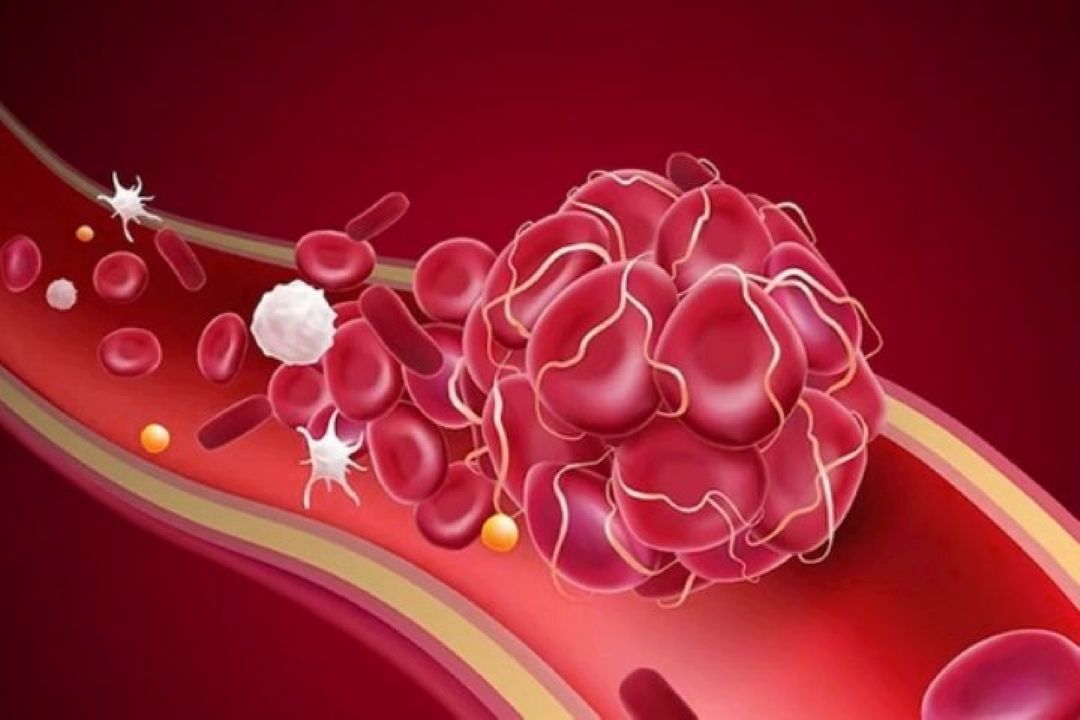 از سردرد تا تنگی نفس؛ نشانه‌های لخته خون