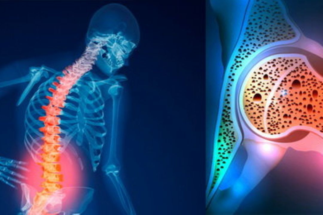 پوكی‌استخوان؛ عارضه‌ای شایع در زنان بالای 60 سال