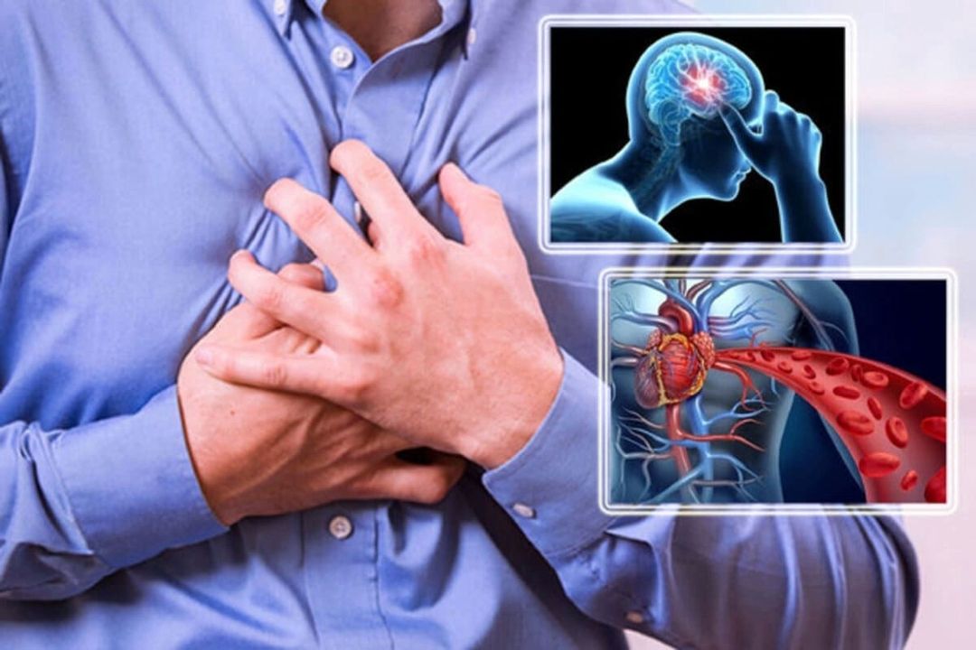 رادیو سلامت؛ در «اینجا طبیب» سكته‌های قلبی و مغزی را هدف گرفت