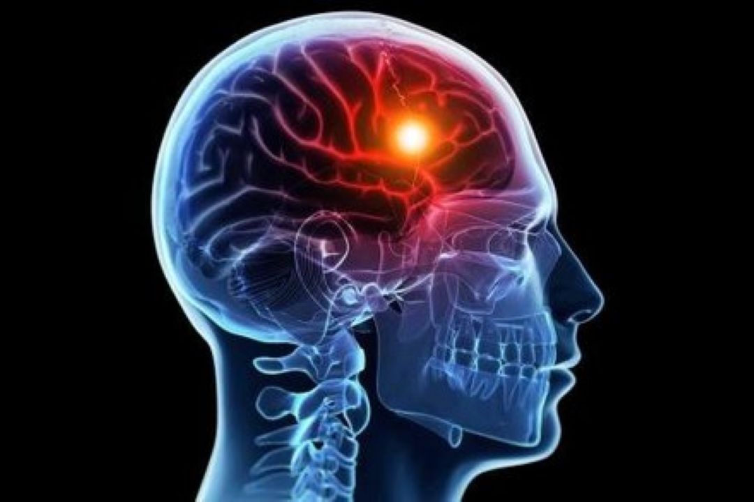 علایم سكته مغزی چیه؟