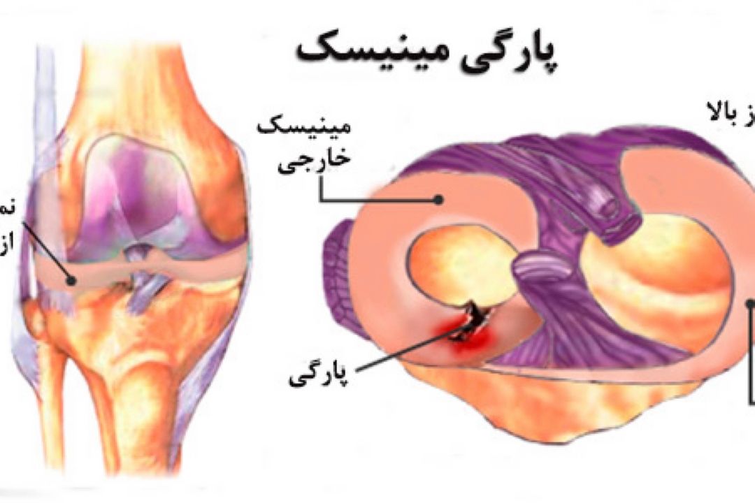 علل پارگی مینیسك زانو و روش درمان 