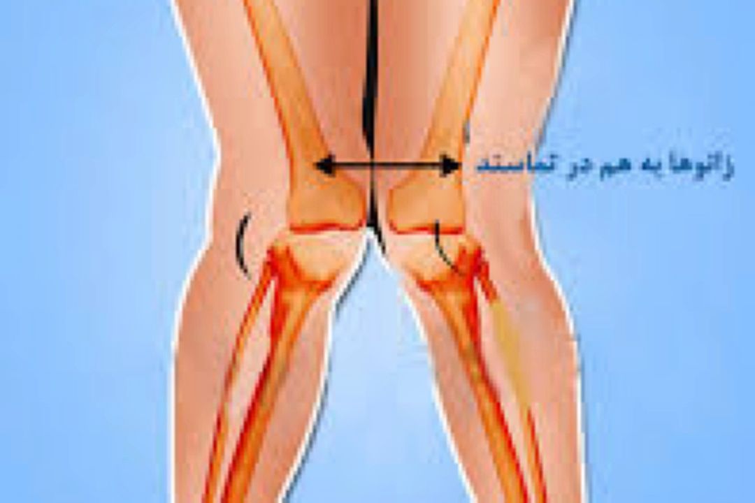زانوی ضربدری، علل و روش درمان