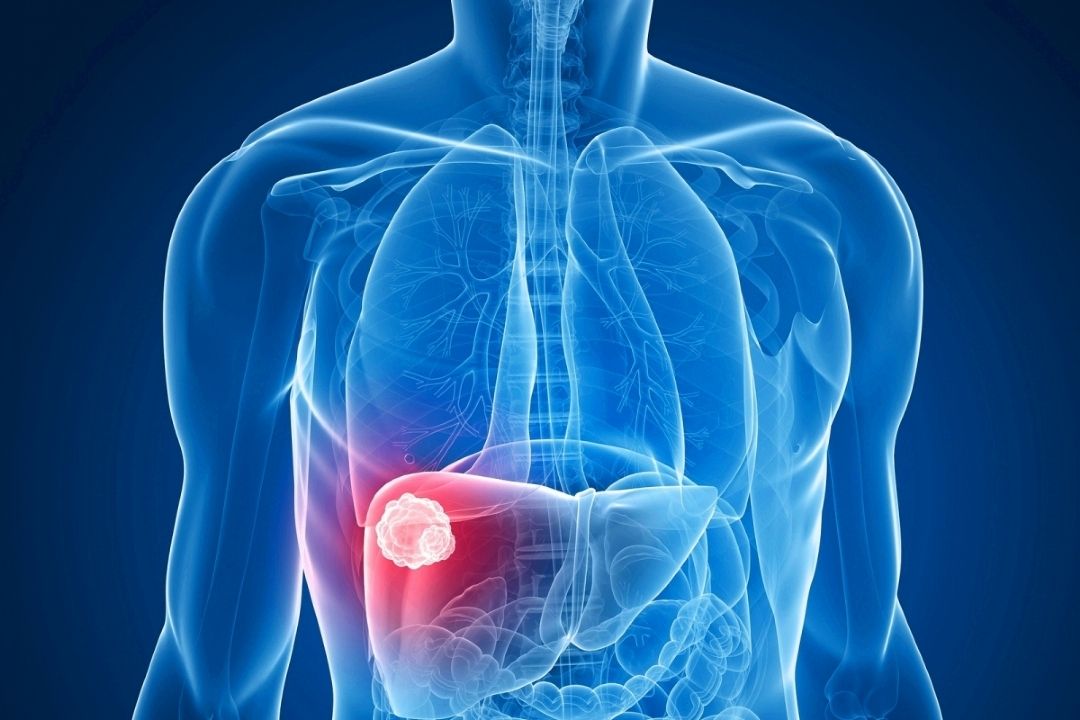 هپاتیت و روش های پیشگیری از آن