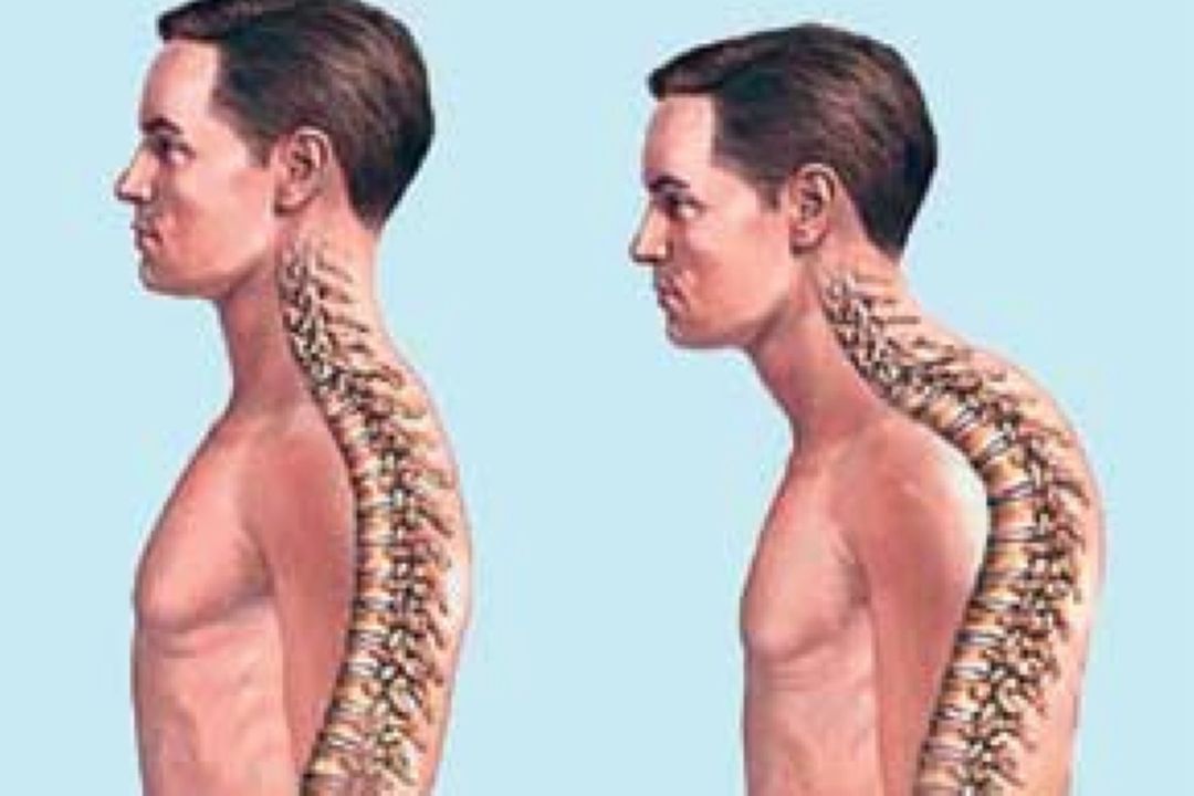 پشت گرد و كوچك شدن قفسه سینه 