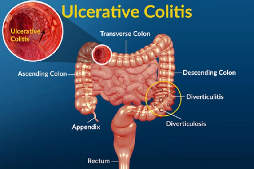 تغذیه مناسب برای مبتلایان به التهاب روده ای در "رادیو سلامت " 