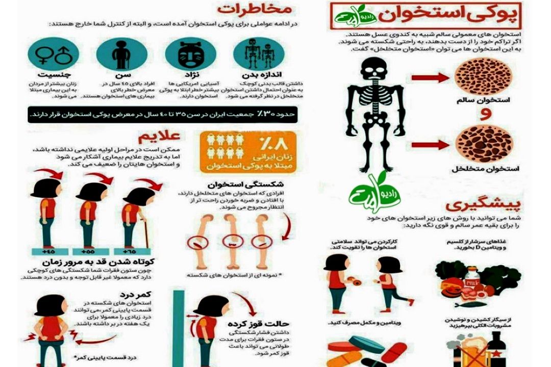مهمترین علائم پوكی استخوان یا استئوپروز در زنان و مردان