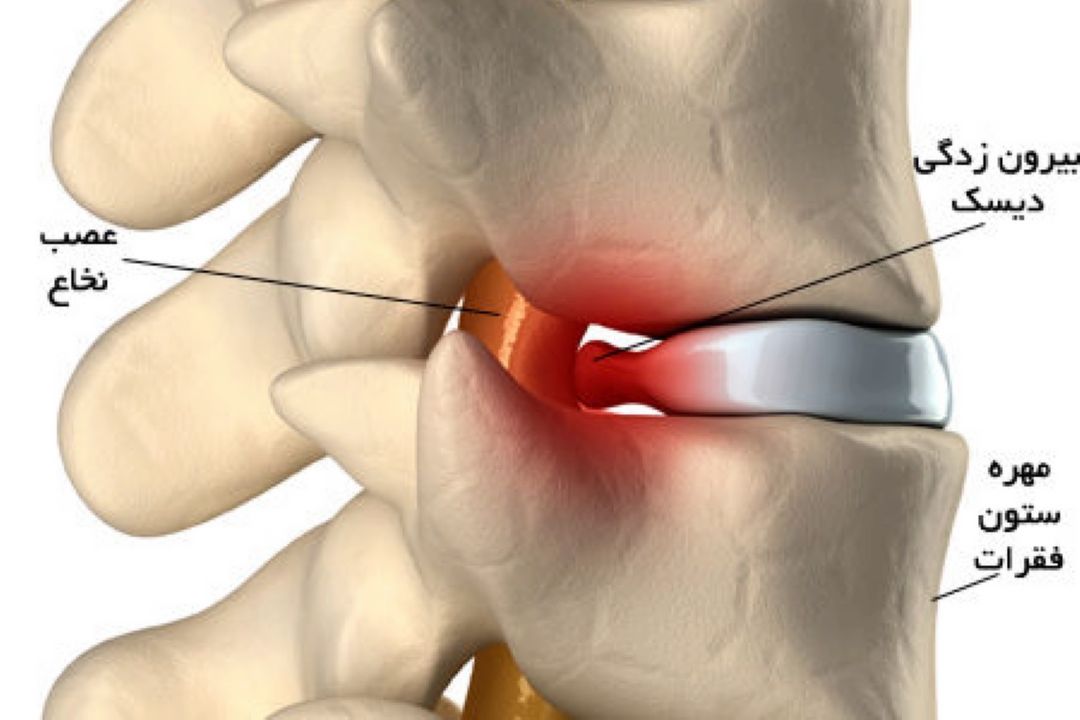 علائم هشدار دهنده دیسك كمر