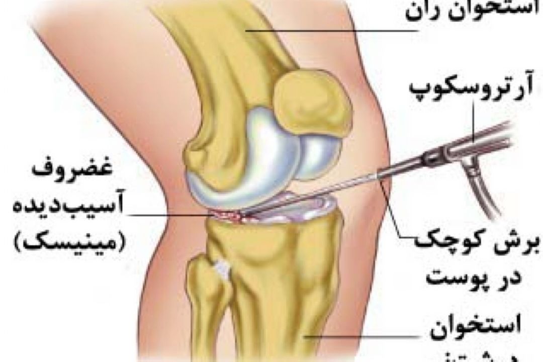 راهكارهای درمانی آسیب ACL و مینیسك 