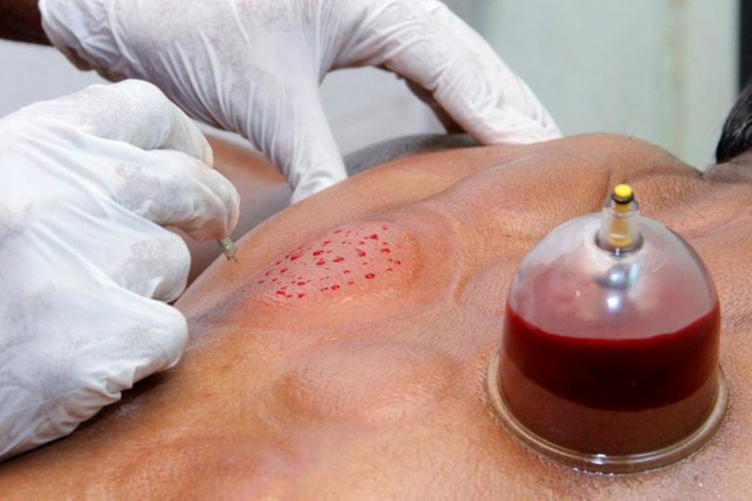 حجامت همچنان یك رفتار پر خطر محسوب می شود
