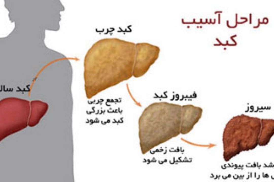 نقش تغذیه و ورزش در پیشگیری و درمان كبد چرب 