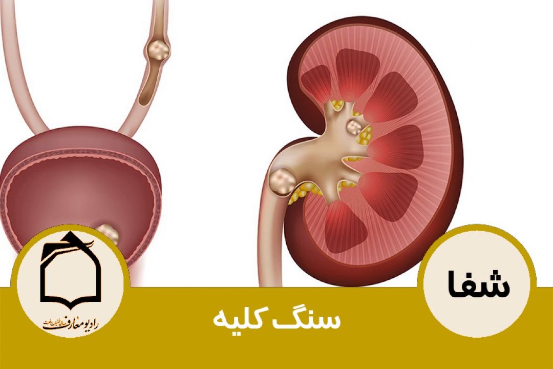 سنگ كلیه