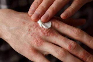 شایع ترین بیماریهای پوستی ناشی از كرونا و فصل گرما+متن گفتگو