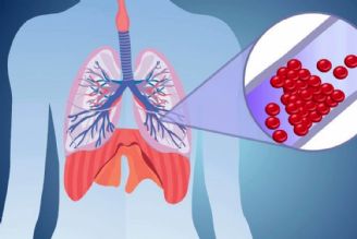 آمبولی ریه چیست؟