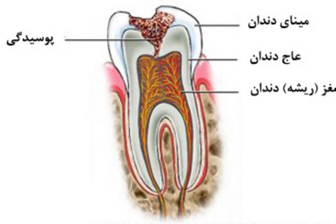 در برنامه نبض چهارشنبه بیست و پنجم مرداد درباره پوسیدگی دندان صحبت میكنیم.