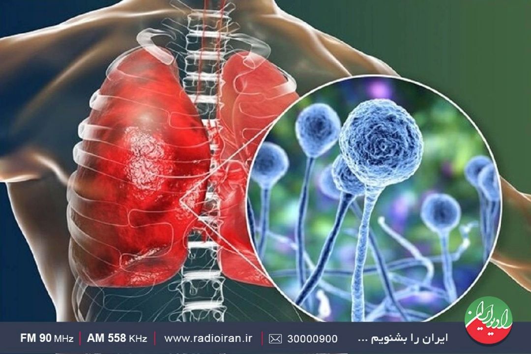  از بیماری «قارچ سیاه» چه می دانید