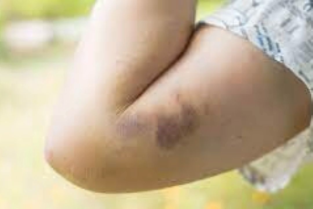 پنج دلیل احتمالی كبودی در بدن