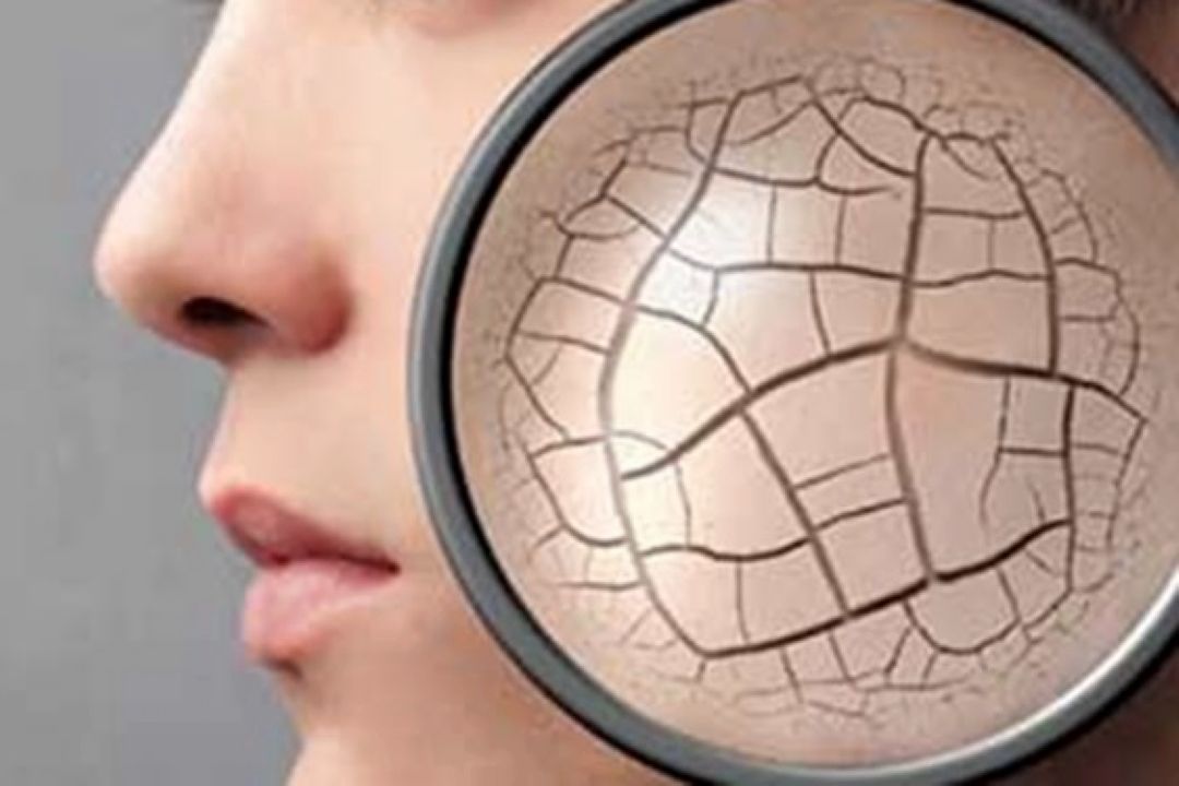 خشكی پوست پاییزی را چگونه درمان كنیم؟