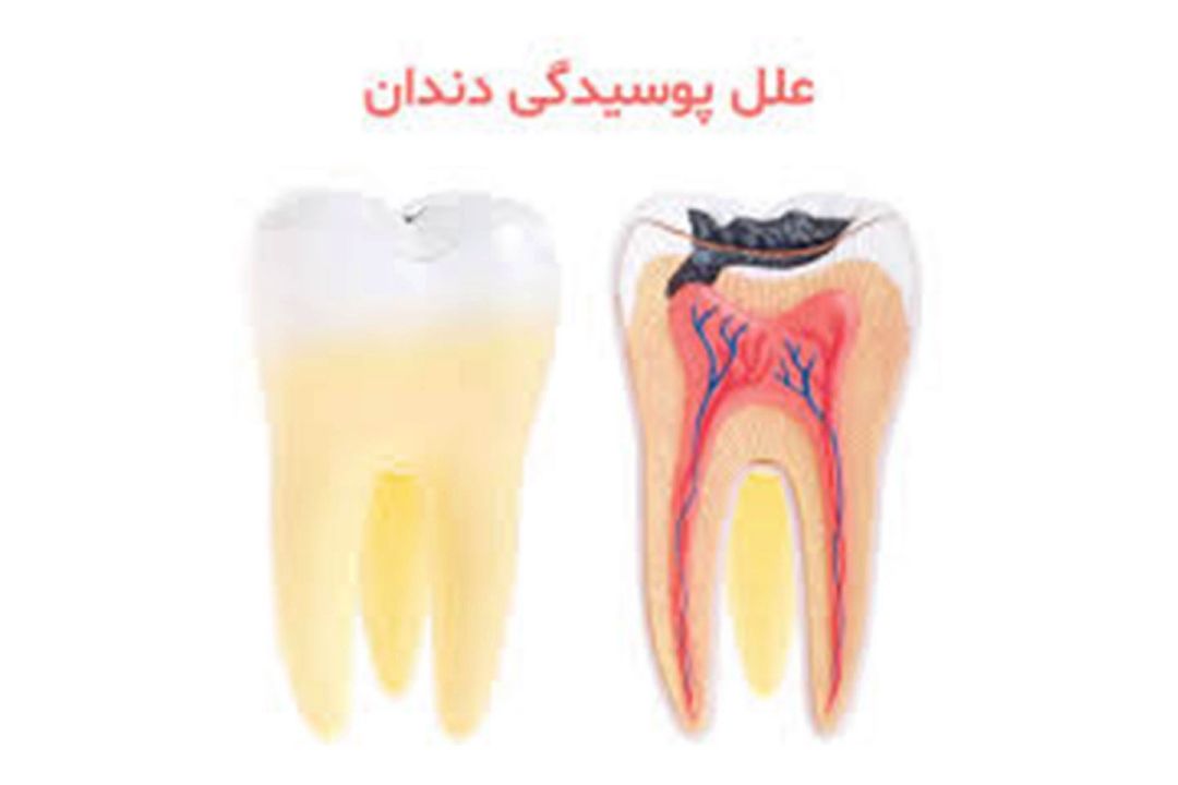 جلوگیری از پوسیدگی دندان ها با استفاده همزمان از مسواك و نخ دندان میسر است