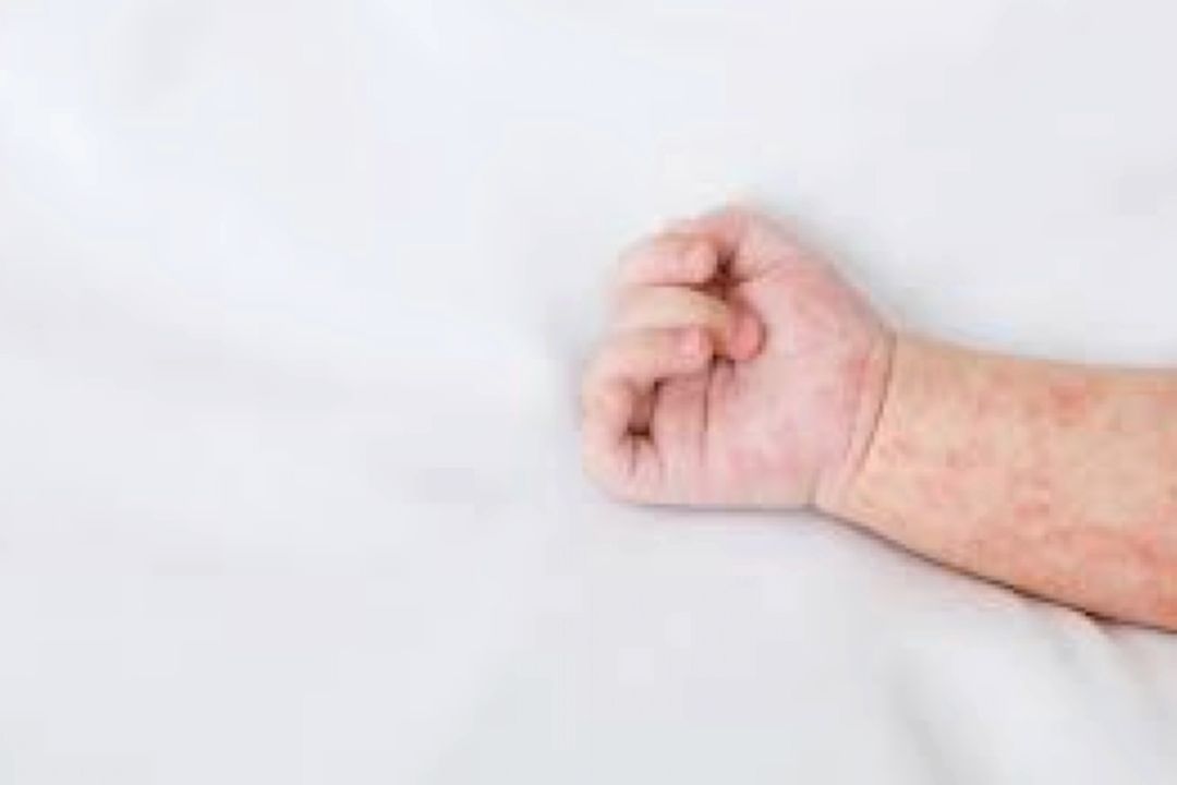 راه های پیشگیری از جولان سرخك