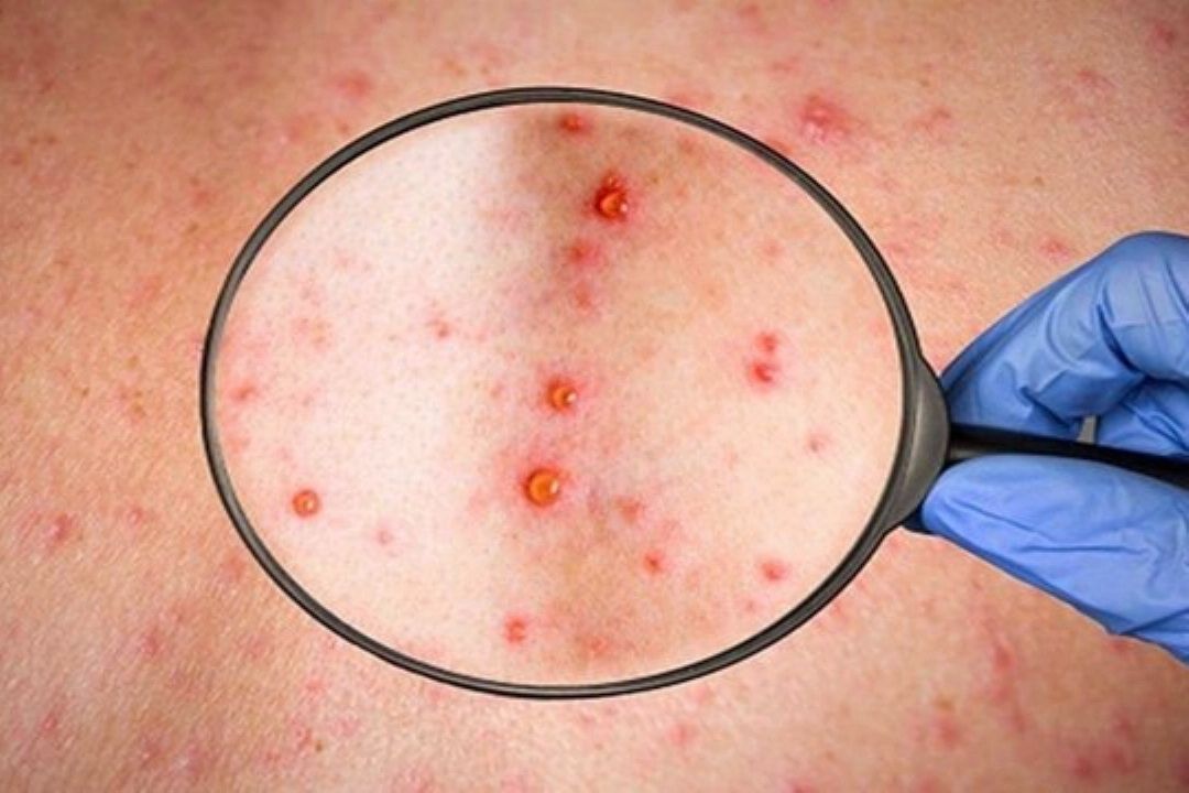 منبع نامشخص آلودگی در طغیان اخیر آبله میمونی/غربالگری تب و بثورات پوستی در مرزها